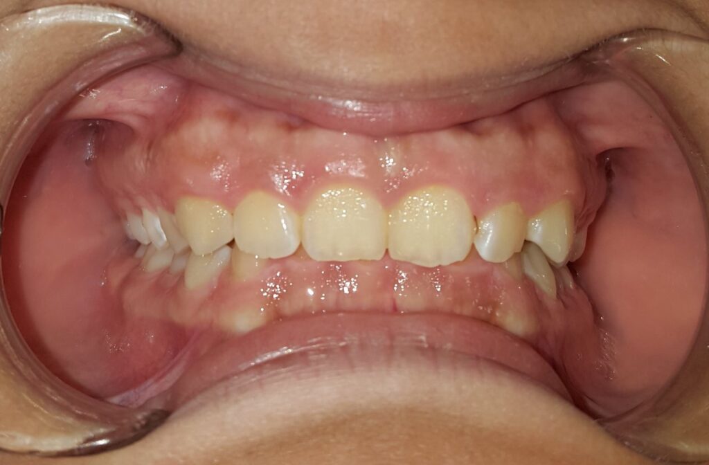 overbite correction, What Types of Braces Work Best to fix Overbite?