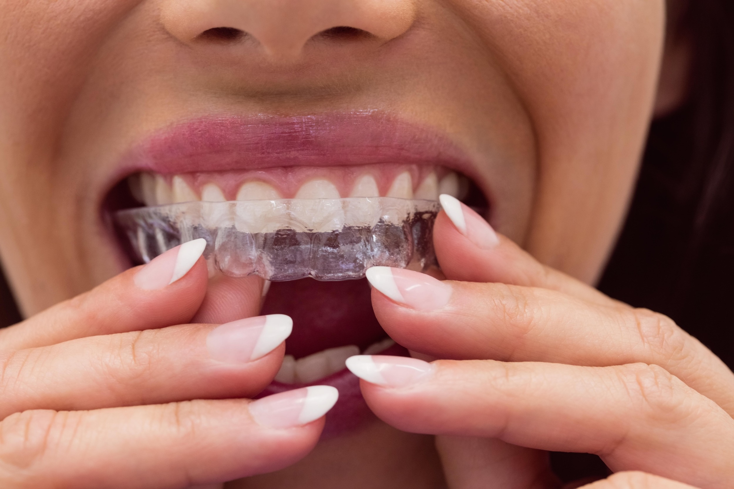 Can You Fix an Overbite With Invisalign®?