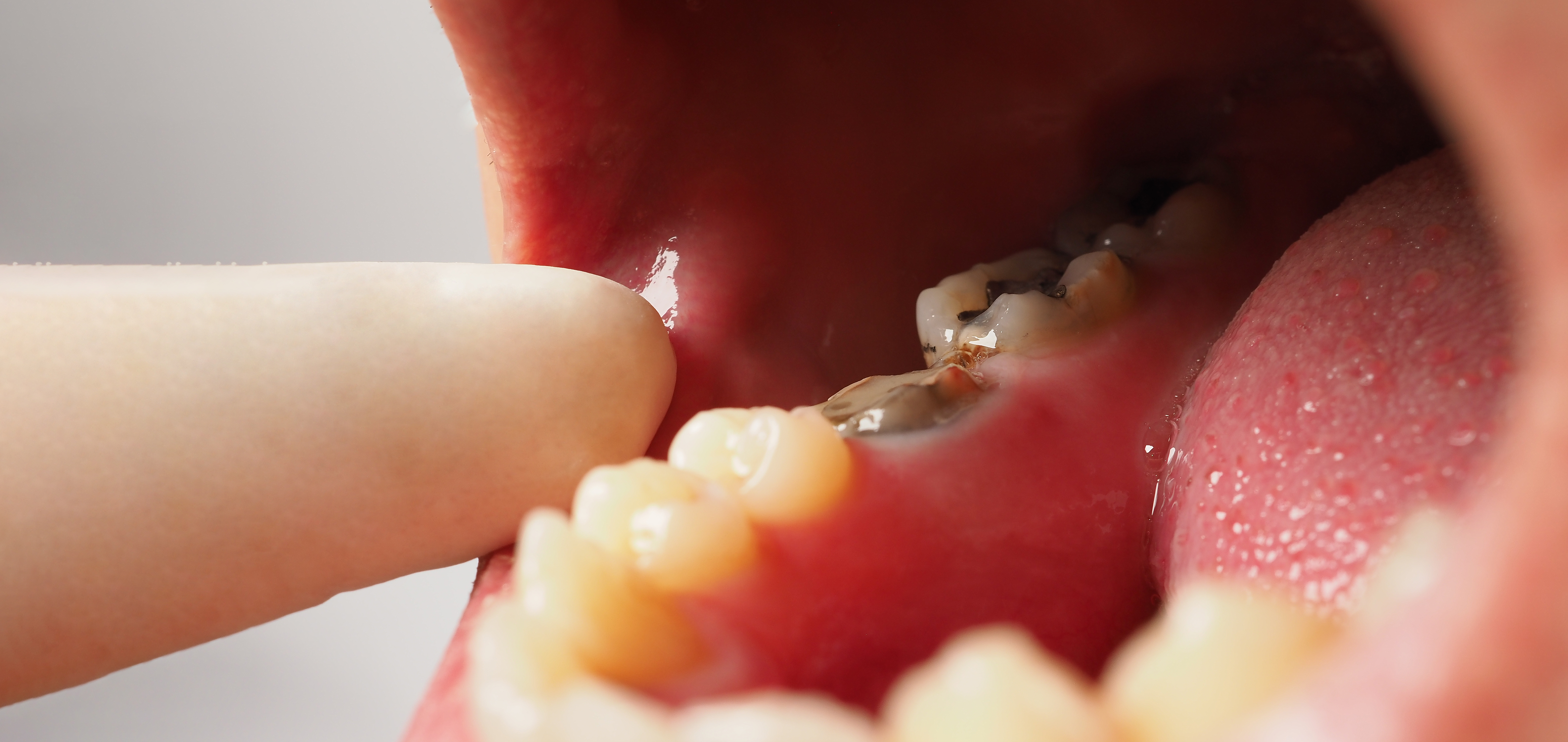 Cavity Between Molars